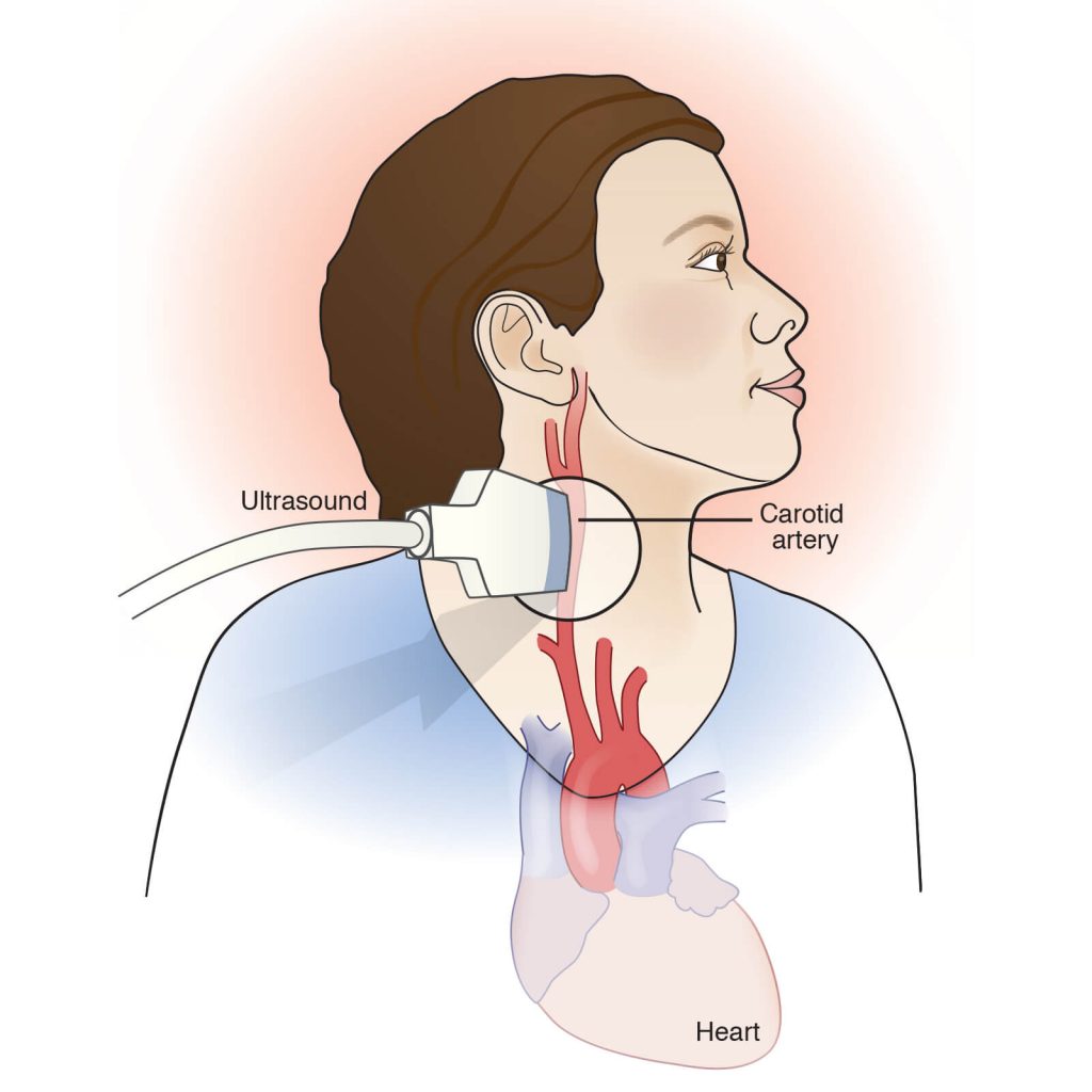 Ultrasound of carotid artery battista illustration