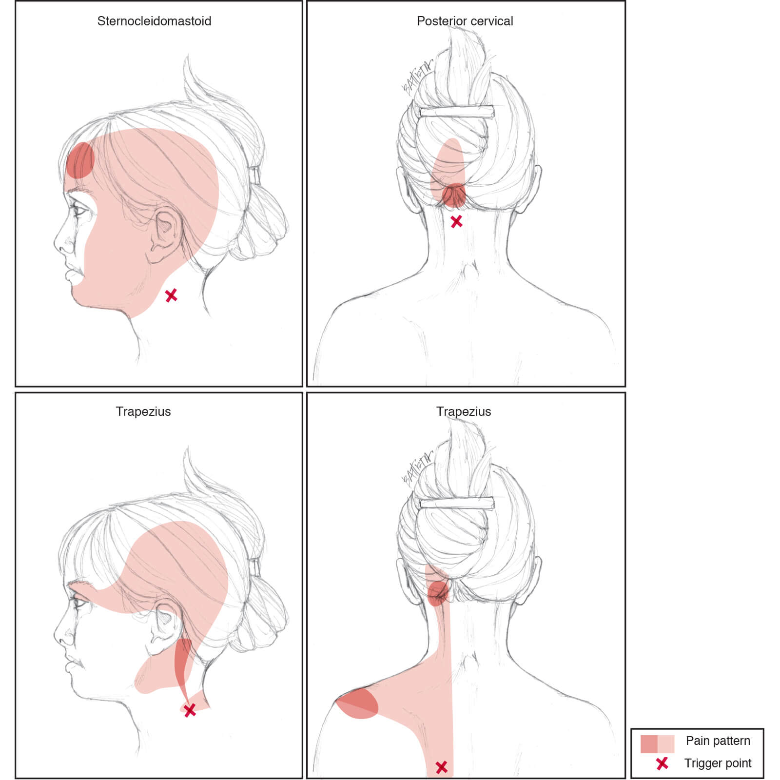 Head And Neck Trigger Points 1° And 2° Pain Patterns Battista